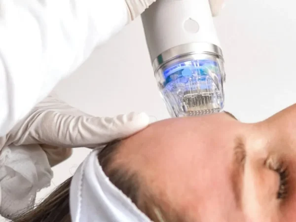 Patient receives RF microneedling facial treatment with specialized device at a clinic in Powell, WY.