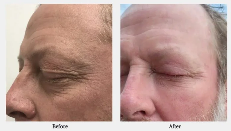Side-by-side before and after photos show a man's crow's feet and facial wrinkles reduced following DYE VL laser treatment in Powell, WY