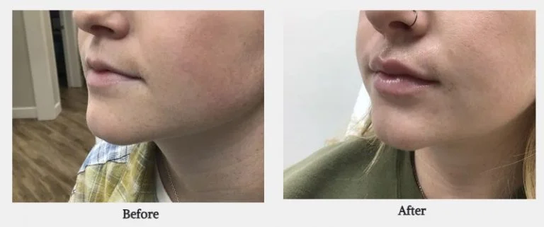 Side-by-side before and after photos show a woman's lips and lower face in Powell, WY, with fuller, more defined lips and smoother skin after filler treatment.