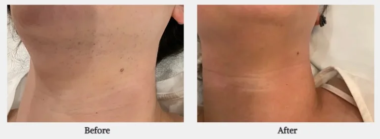 Before and after photos show reduced hair and smoother skin on a woman’s neck after hair removal in Powell, WY.