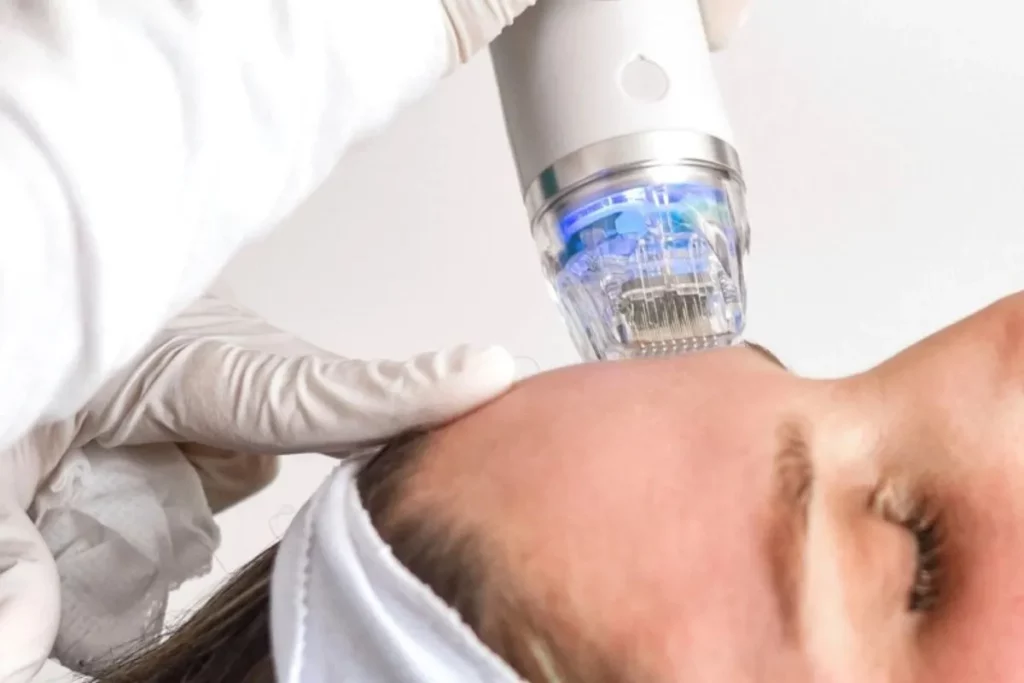 Patient receives RF microneedling facial treatment with specialized device at a clinic in Powell, WY.