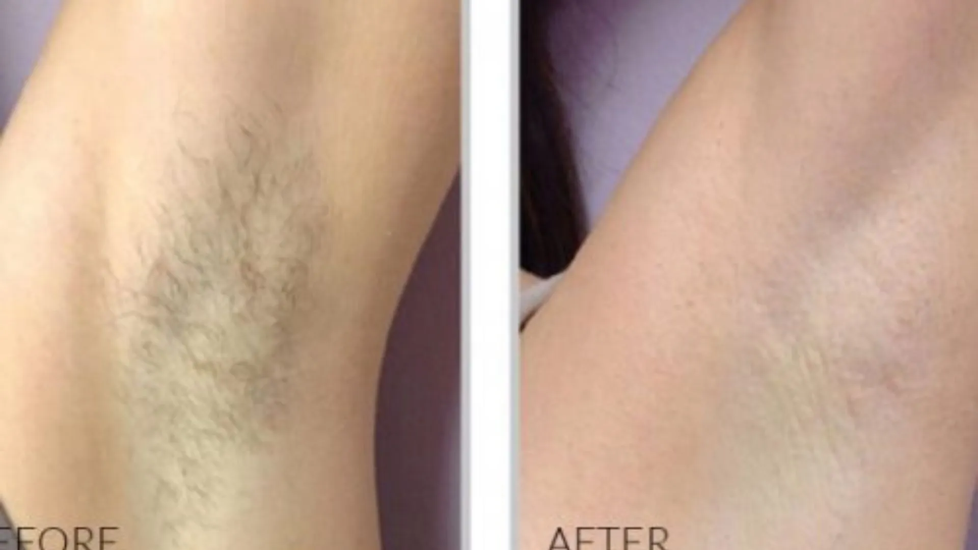Before and after photos show hair-free underarms following Alma laser hair removal in Powell, WY.