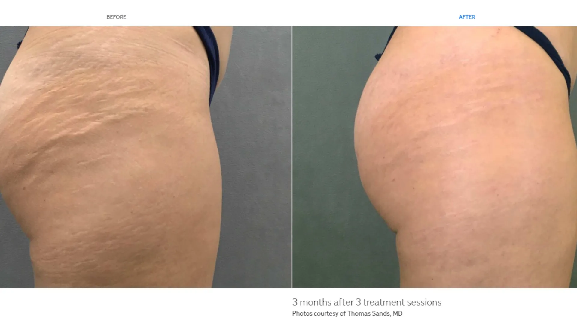 Before and after photos show smoother, firmer buttocks after Cutera treatments in Powell, WY.