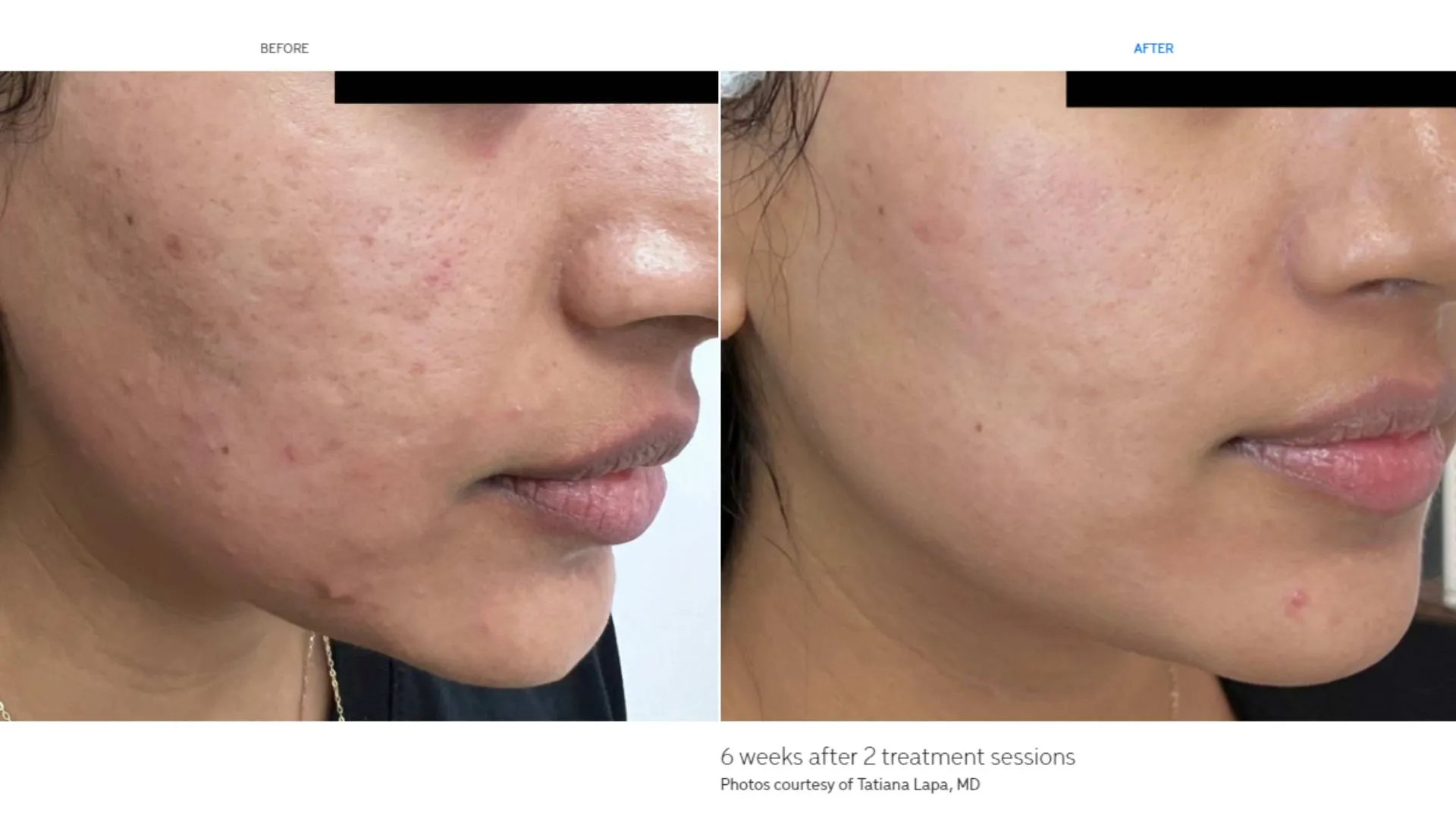 Before and after photos show smoother, firmer face after Cutera treatments in Powell, WY.
