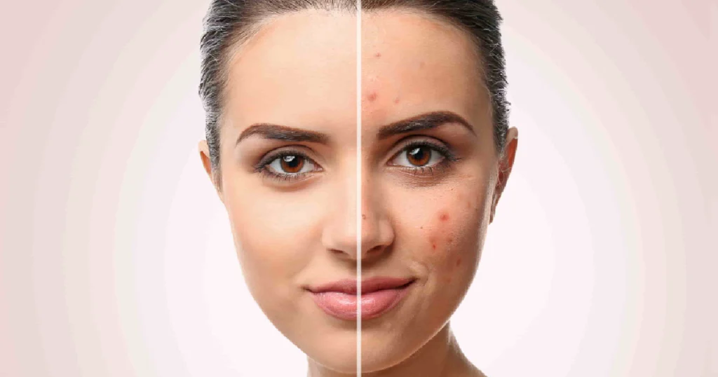 Acne Scar Treatments in Powell, WY