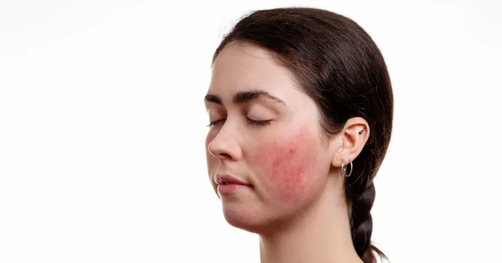 Woman with facial rosacea seeking professional skin care options in Powell, WY