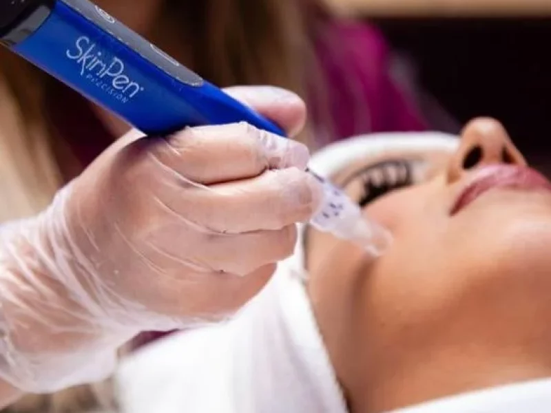 Gloved professional uses a SkinPen device for microneedling on a patient’s arm in Powell, WY.